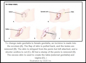 Body Mutilation at Taxpayers' Expense? Encyclopedia of Surgery graphic of "Sex Reassignment Surgery" for "male-to-female" transsexuals.